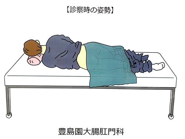 痔疾患の体位イラスト